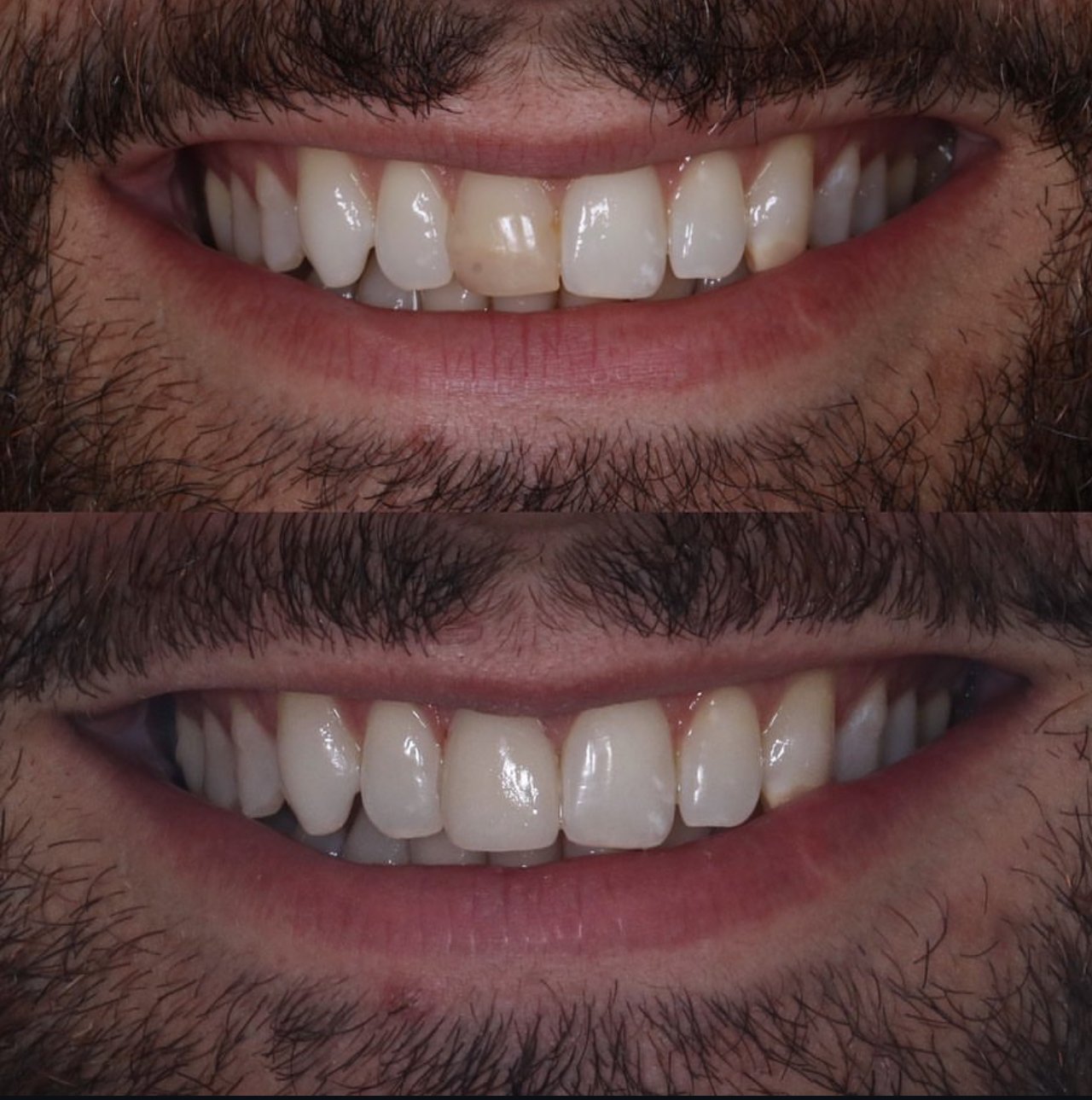 Planificación digital de carillas